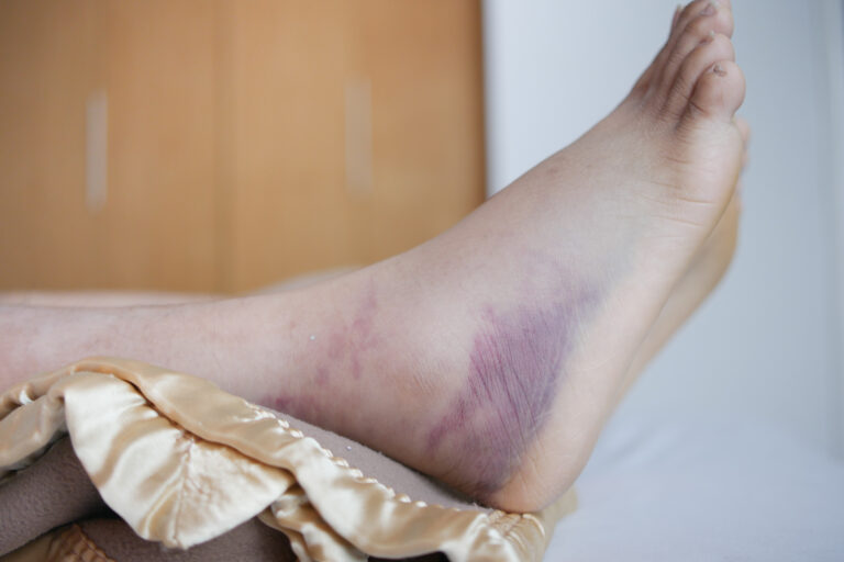 Ankle Sprain Treatment in Cincinnati: Your Guide to Fast Recovery with SoftWave Therapy