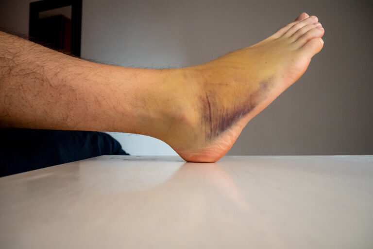 Sprained Ankle Recovery Timeline: What’s Normal and When to Get Help