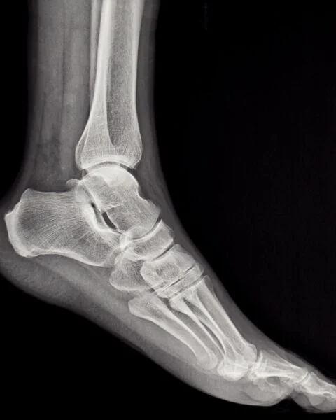 Lateral X-ray view of a human foot and ankle, displaying the bones of the lower leg, ankle, tarsals, metatarsals, and phalanges against a black background.